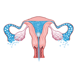 FemVue® - Sono HSG - IVF Store
